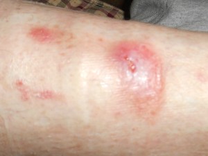 Mommy A's leg ouchie