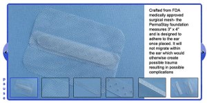 permastay ear implants